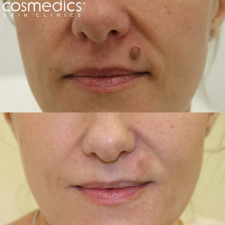 Before And After Photos London Mole Removal
